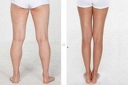 Calf Reduction before & After clinic in Dubai