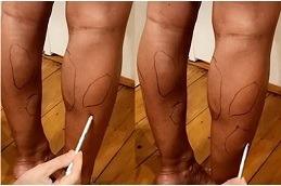 Calf Reduction before & After in Dubai