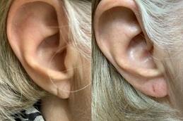 Ear Piercing Before & After Clinic Dubai
