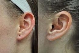 Ear Piercing Before & After Dubai