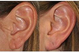 Ear Piercing Before & After Dubai