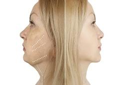 Jawline Surgery before & After Dubai