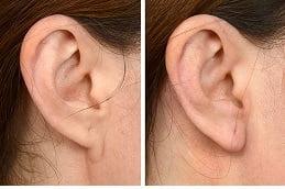Results OF Ear Piercing Dubai