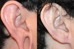 Results OF Ear Piercing clinic in Dubai