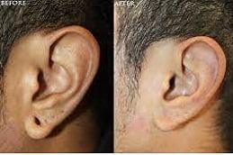 Results OF Ear Piercing in Dubai