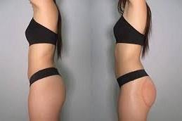 Results of Buttock Lift Dubai
