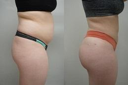 Results of Buttock Lift clinic in Dubai
