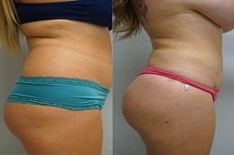 Results of Buttock Lift in Dubai