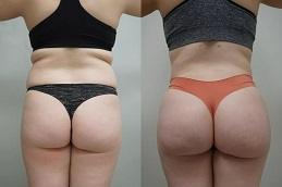 Results of Buttock Lift in Dubai