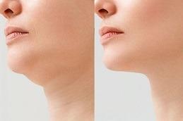 Results of Jawline Surgery clinic in Dubai