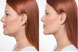 Double Chin Removal Before & After Clinic in Dubai