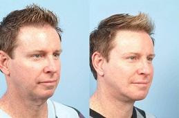 Double Chin Removal Before & After Clinic