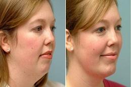 Double Chin Removal Before & After Dubai