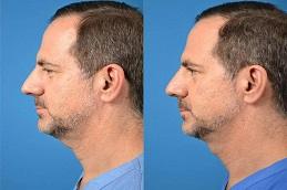 Double Chin Removal Before & After in Dubai