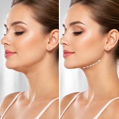 Double Chin Removal in Dubai & Abu Dhabi