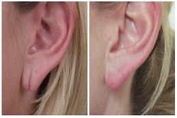 Earlobe Correction Surgery Before & After in Dubai & Abu Dhabi