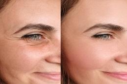 Facial Treatment BEFORE and aFter Dubai