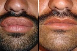 Lip Reduction Surgery Before & After Dubai