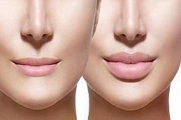 Lip Reduction Surgery Before & After clinic in Dubai