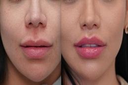 Lip Reduction Surgery Before & After in Dubai