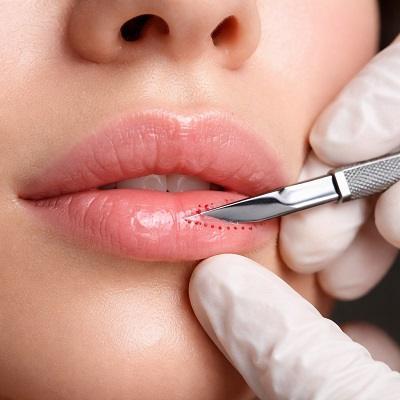Lip Reduction Surgery in Dubai & Abu Dhabi