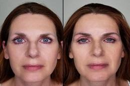 Microblading before & After clnic in Dubai