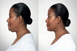 Results OF Double Chin Removal clinic in Dubai