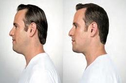 Results OF Double Chin Removal in Dubai