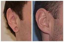 Results OF Earlobe Correction Surgery clinic in Dubai