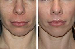 Results OF Lip Reduction Dubai