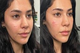 Results OF Teosyal Redensity 2 Under Eyes Dubai