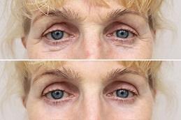 Results OF Teosyal Redensity 2 Under Eyes clinic in Dubai
