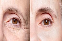 Results OF Teosyal Redensity 2 Under Eyes in Dubai