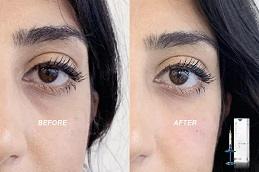 Teosyal Redensity 2 Under Eyes Before & After Clinic in Dubai