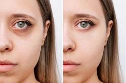 Teosyal Redensity 2 Under Eyes Before & After in Dubai