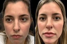 Teosyal Redensity 2 Under Eyes Before & After