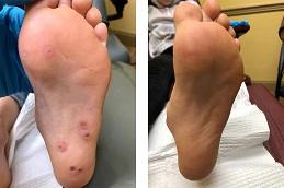 Warts Removal Treatment before & After Dubai & Abu Dhabi