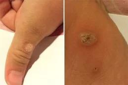 Warts Removal Treatment before & After Dubai
