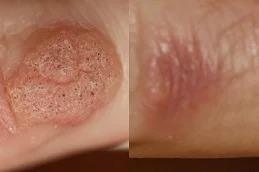 Warts Removal Treatment before & After clinic in Dubai & Abu Dhabi