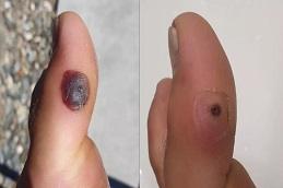 Warts Removal Treatment before & After in Dubai & Abu Dhabi