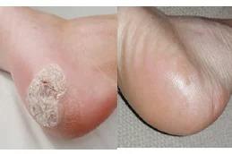 Warts Removal Treatment before & After in Dubai