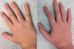 Warts Removal Treatment before & After