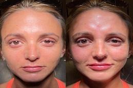 Allergan Fillers before and After,