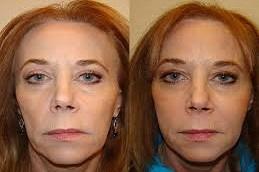 Allergan Fillers before and After Dubai