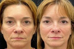 Allergan Fillers before and After clinic Dubai