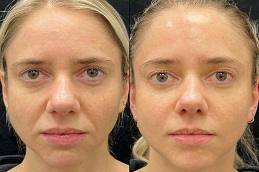 Allergan Fillers before and After clinic in Dubai