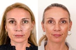 Allergan Fillers before and After in Dubai