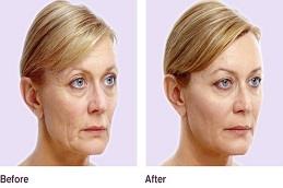 Allergan Fillers before and After