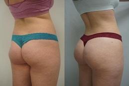 Butt Fillers Before and After Dubai