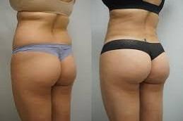 Butt Fillers Before and After clinic in Dubai